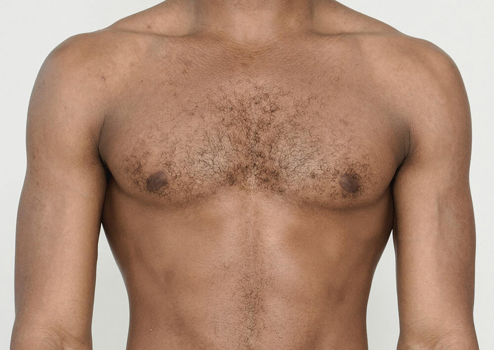 gynecomastia surgery