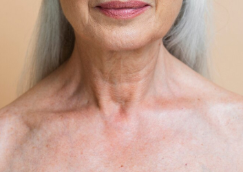 melasma procedure