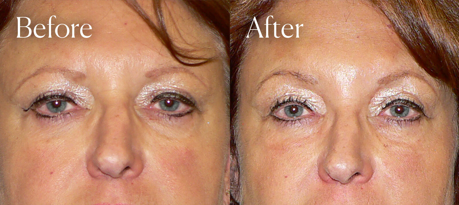 browlift surgery enhancements