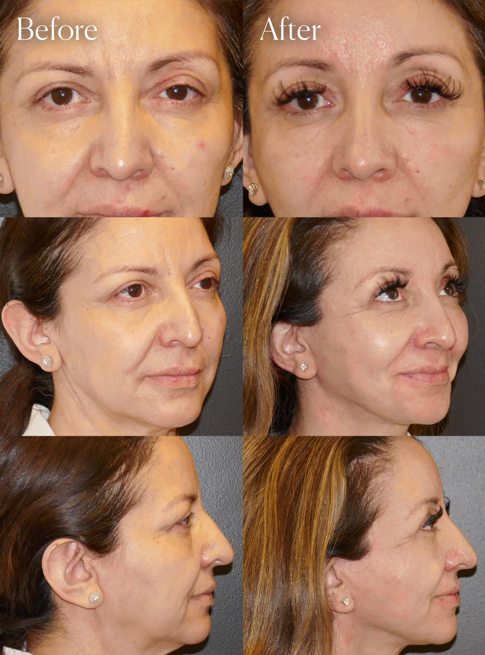 browlift surgery