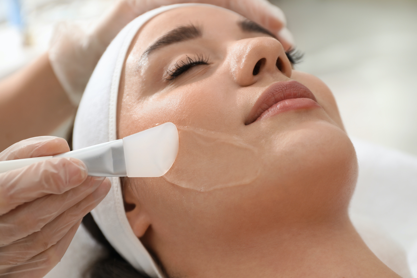 chemical face peel