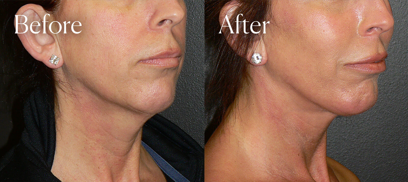 chin implant plastic surgery