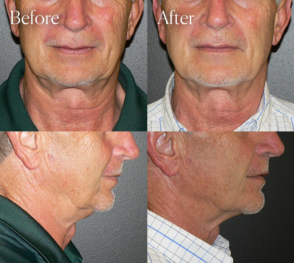 chin implant procedure