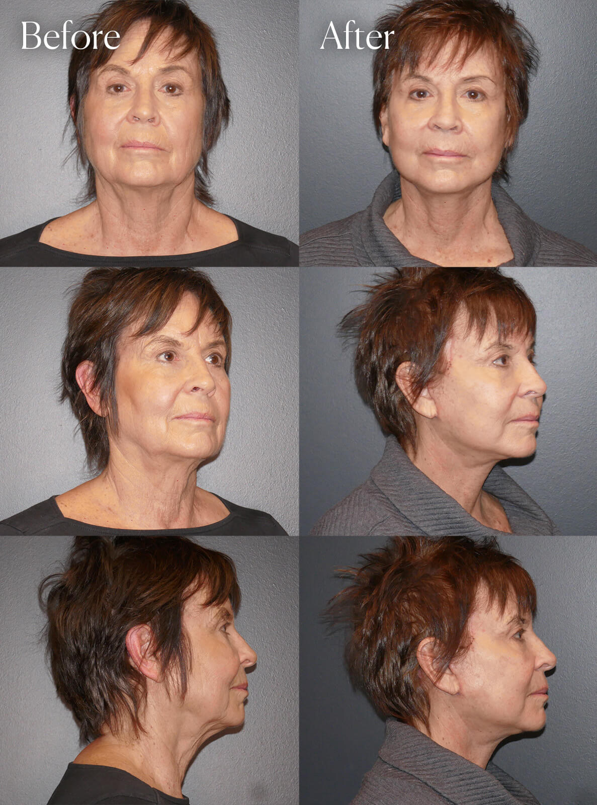 deep plane facelift necklift procedure