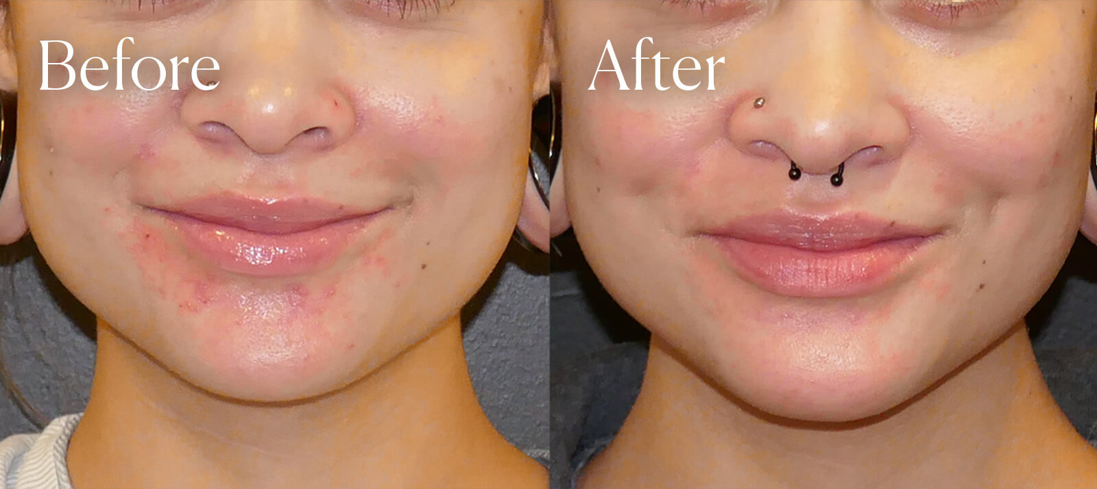 dimpleplasty facial enhancements