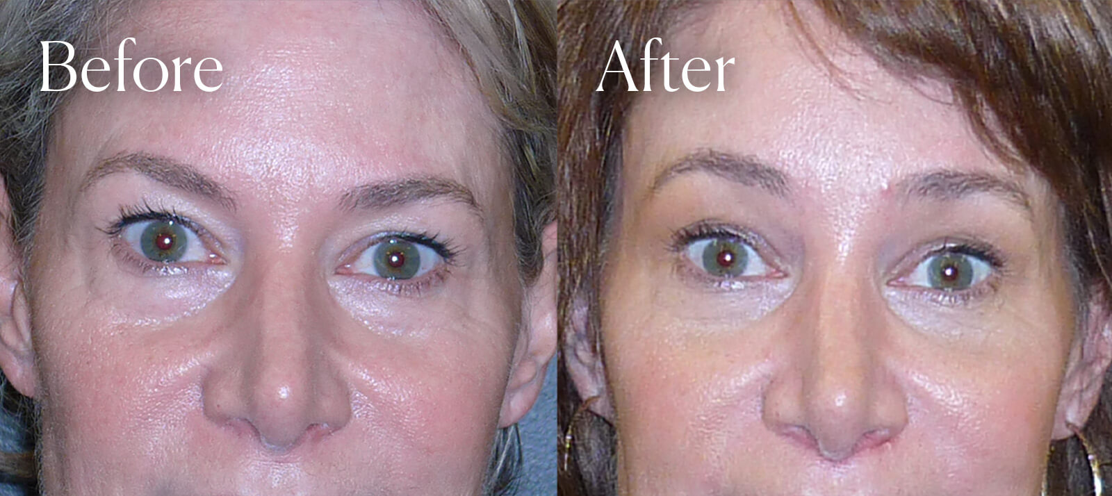 endo browlift aesthetic surgery