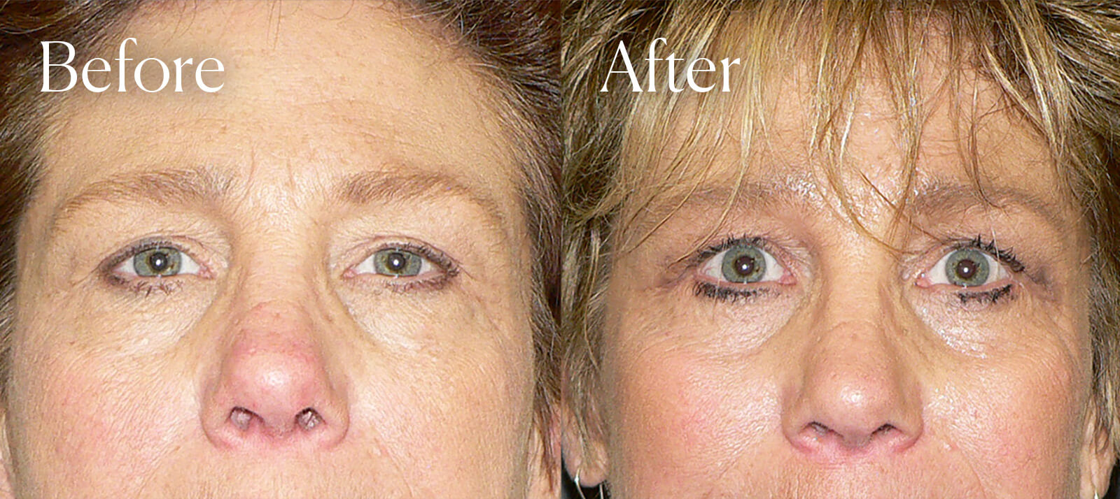 endo browlift plastic surgery