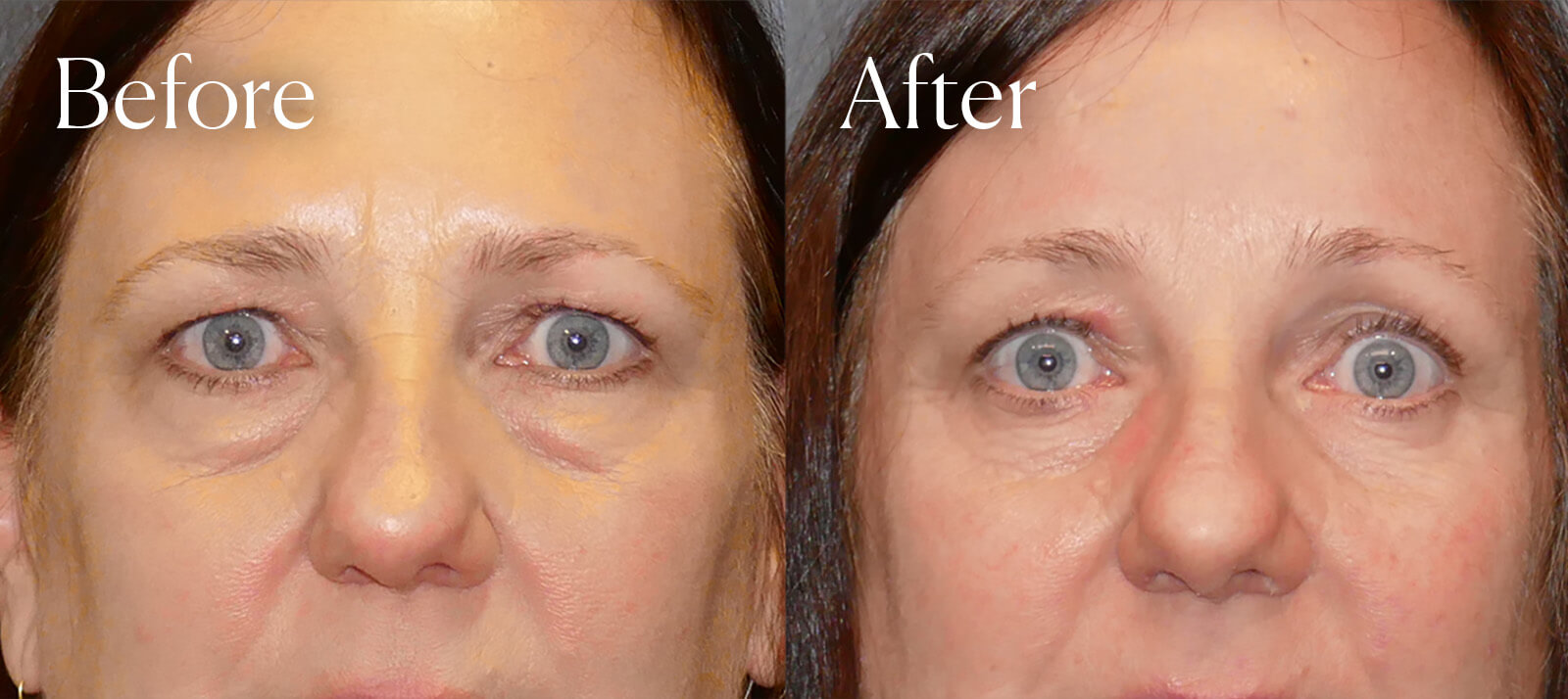 endo browlift procedure