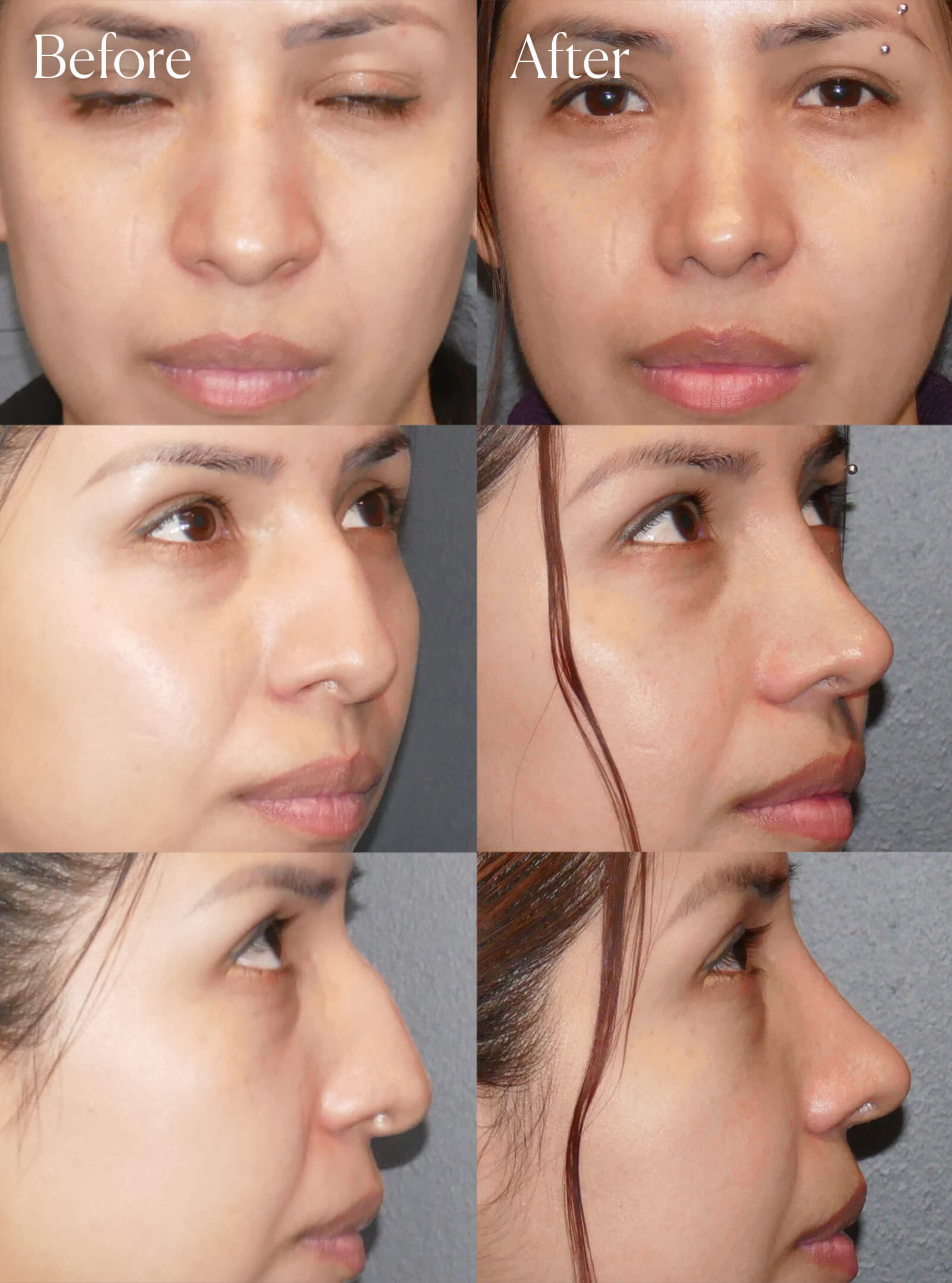 ethnic rhinoplasty plastic surgery