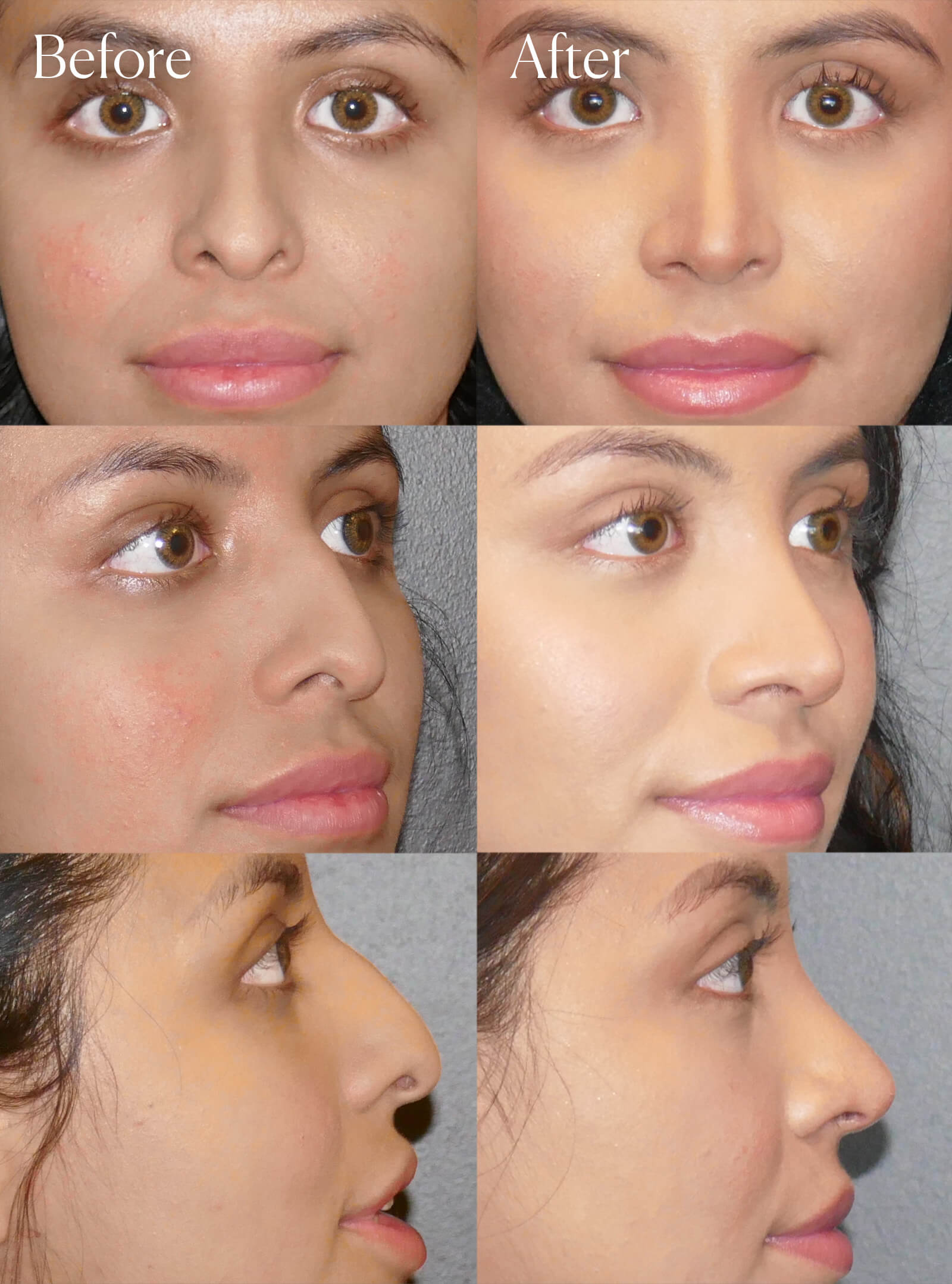 ethnic rhinoplasty procedure colorado