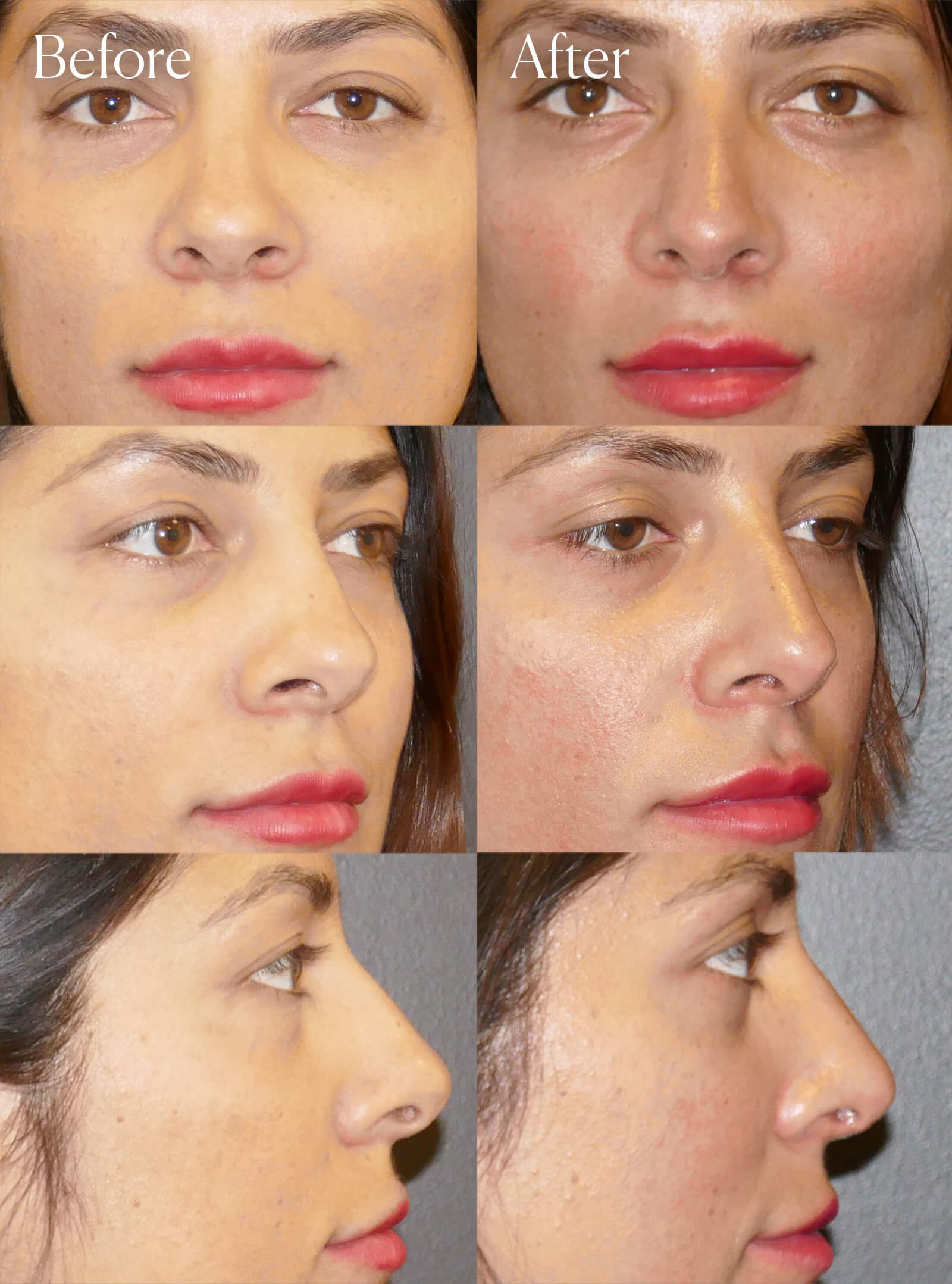 ethnic tip rhinoplasty surgery results