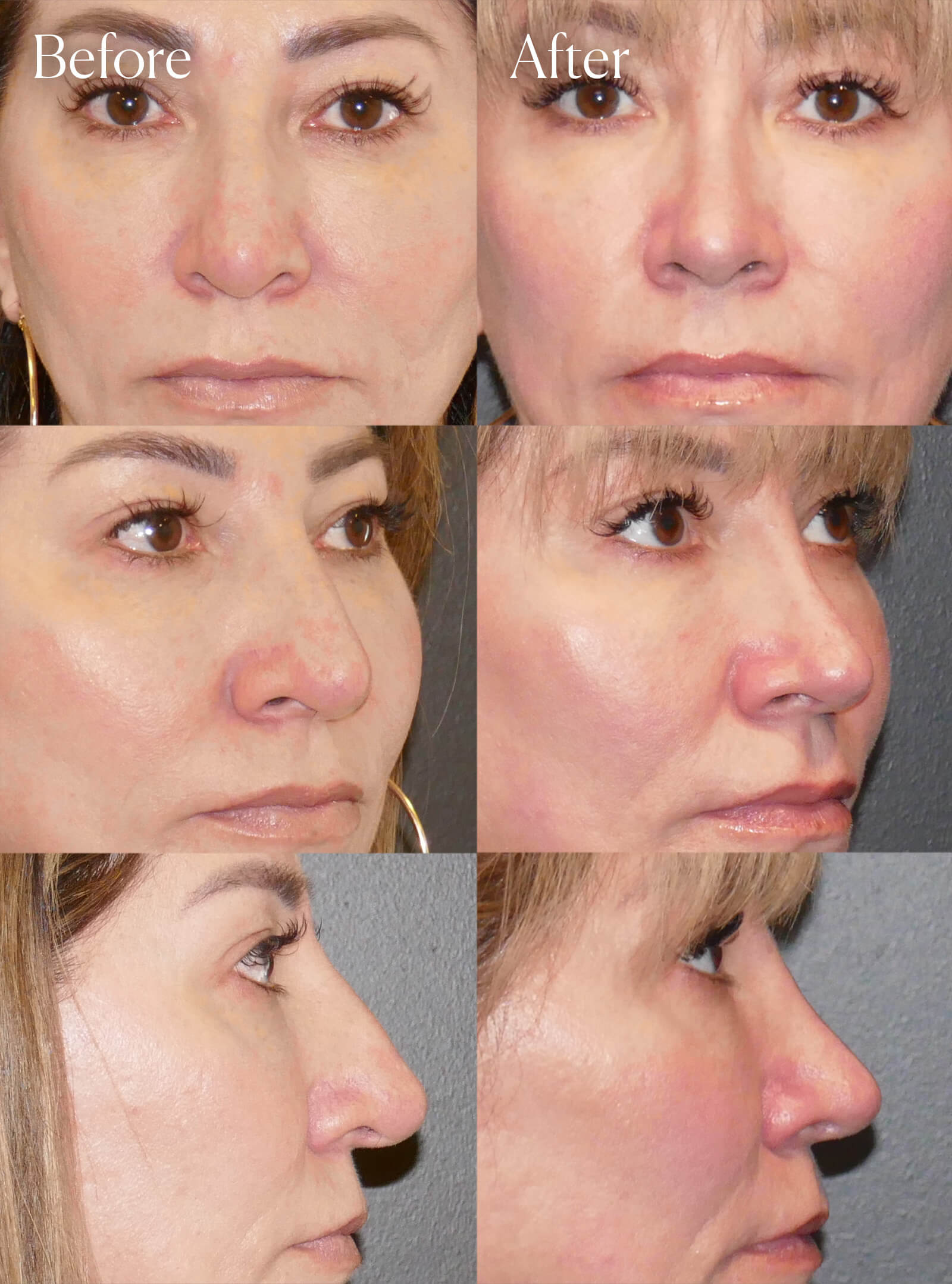 ethnic ultrasonic rhinoplasty procedure colorado