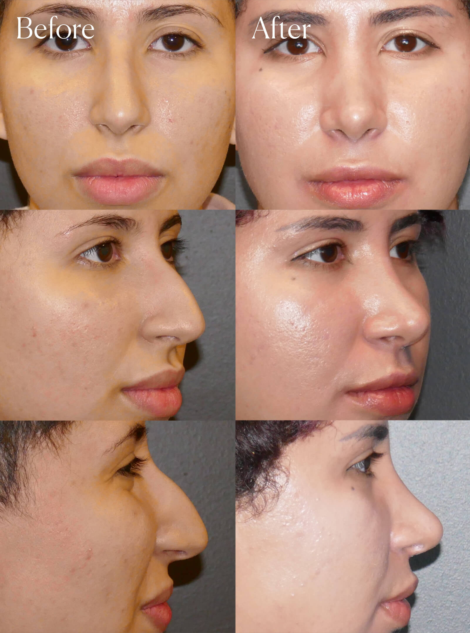 ethnic ultrasonic rhinoplasty surgery enhancements