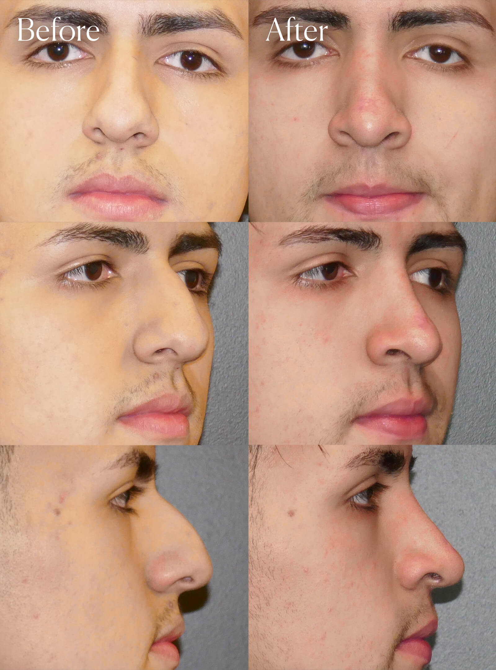 ethnic ultrasonic rhinoplasty surgery results