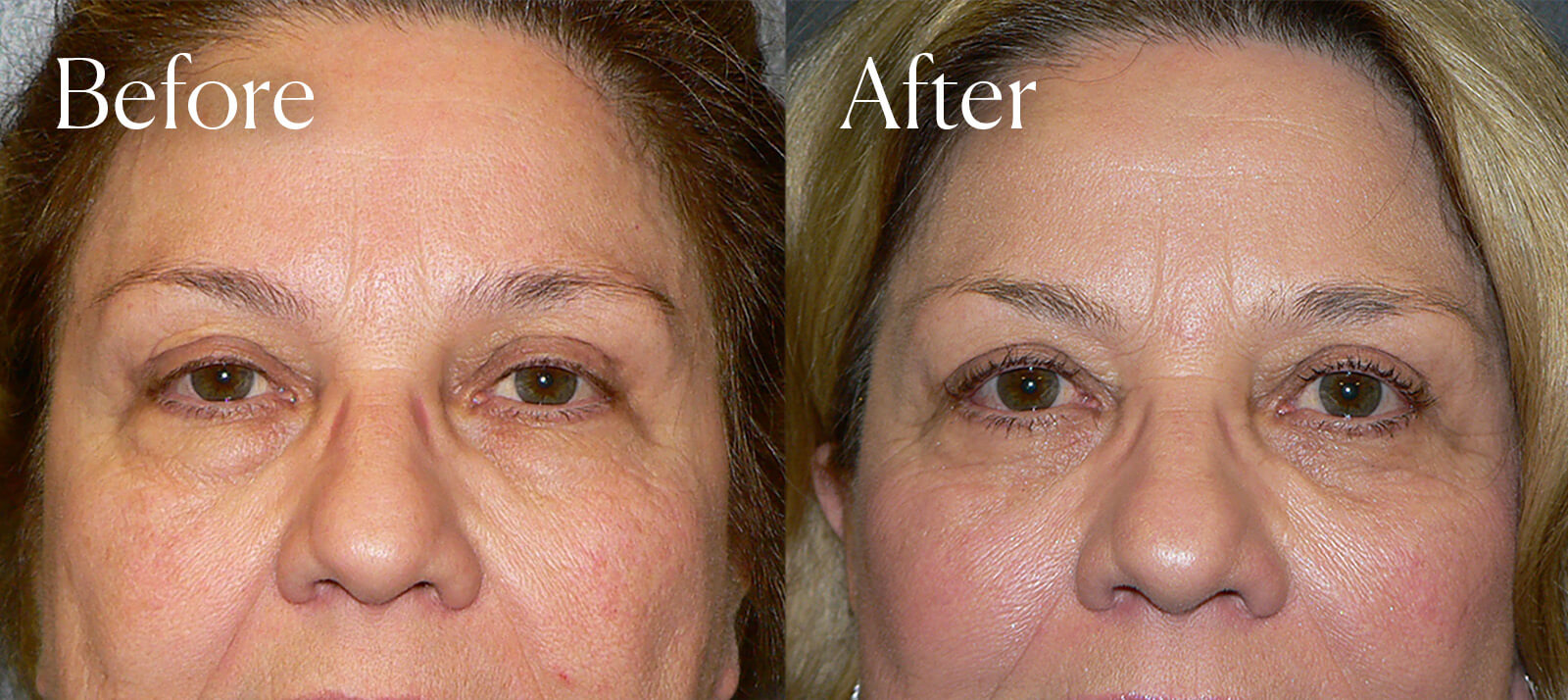 eyelid lift surgery enhancements