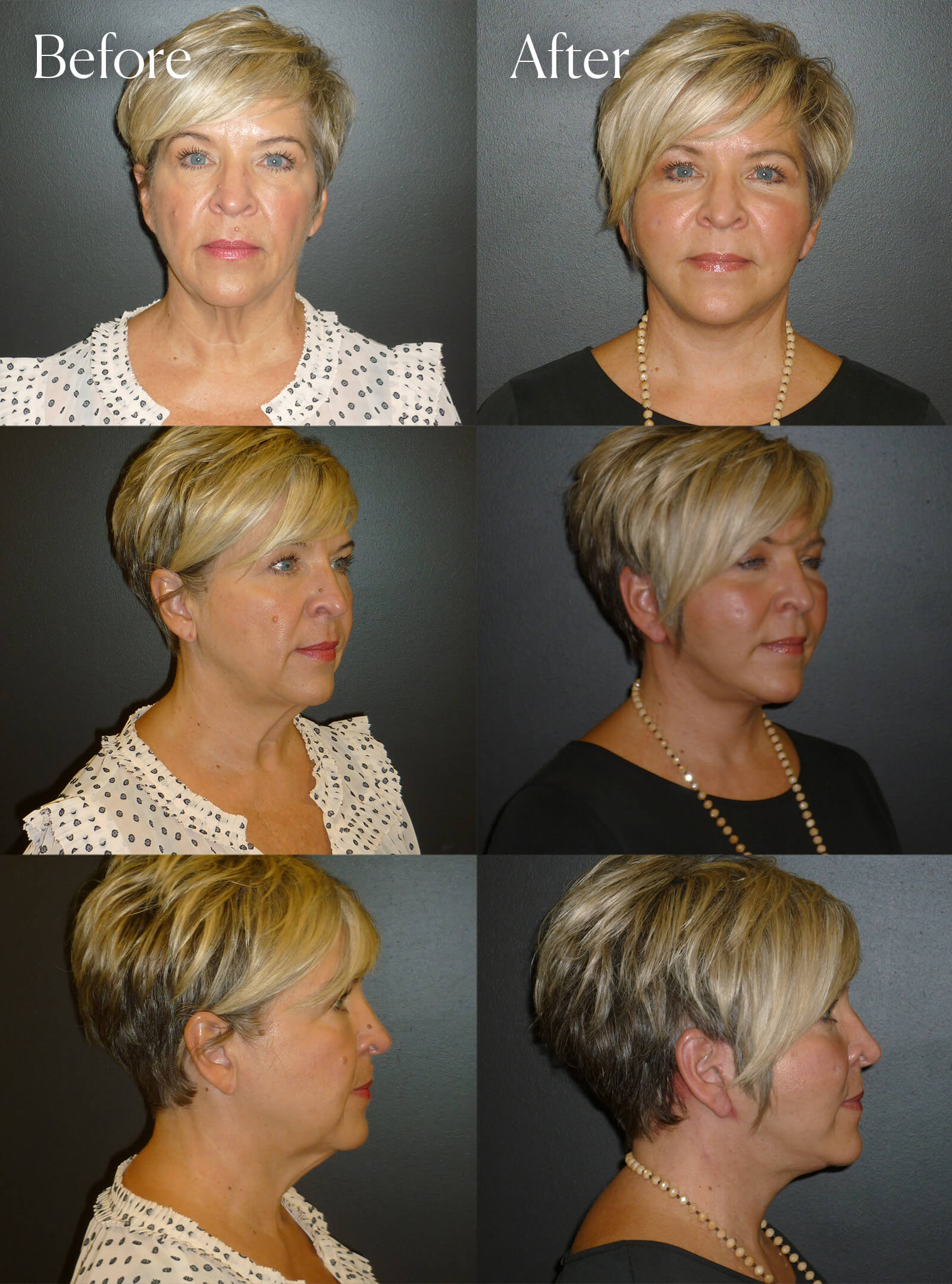 facelift surgery enhancements