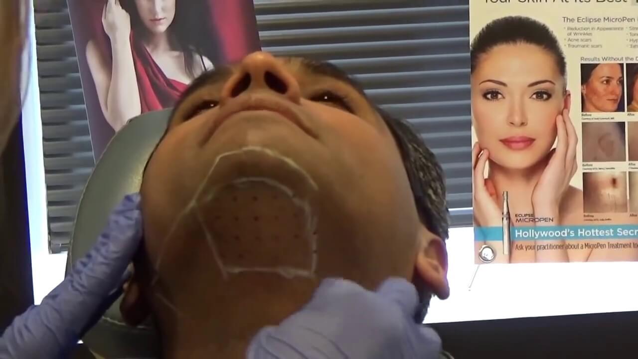 fat melting kybella shot video