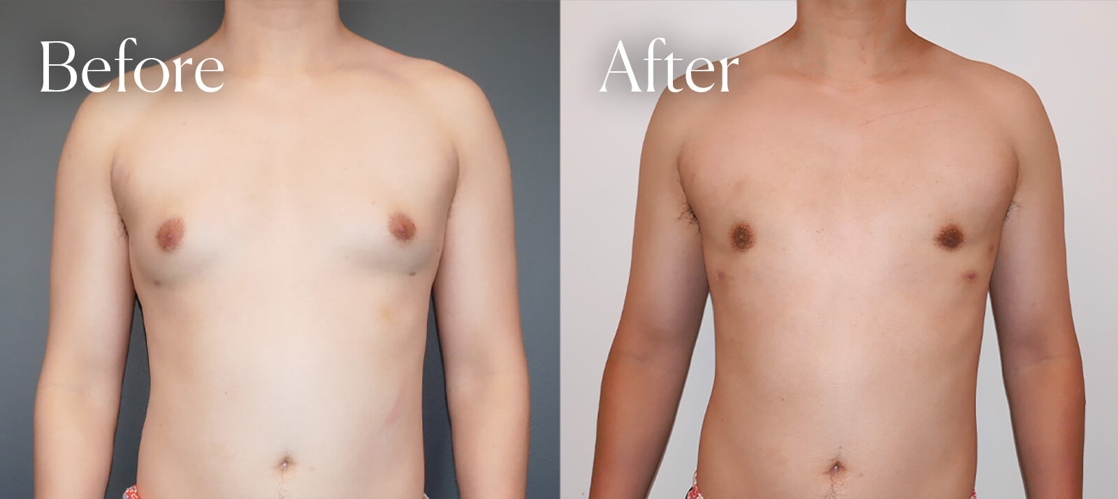 gynecomastia bilateral procedure