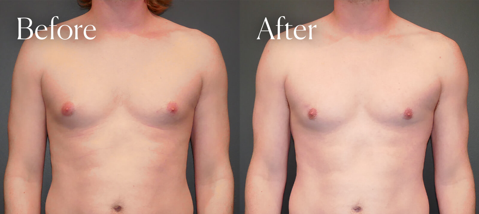 gynecomastia bilateral surgery