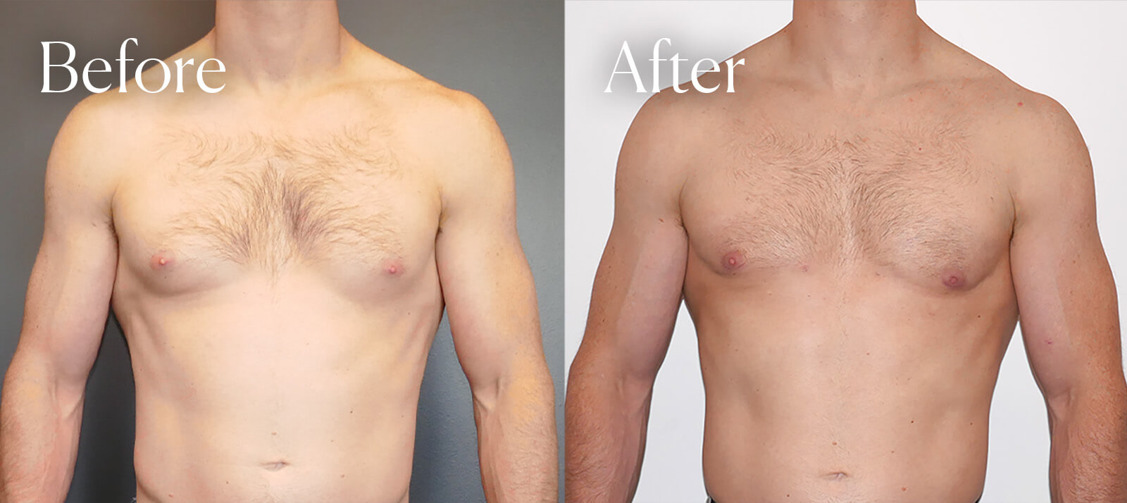 gynecomastia plastic surgery