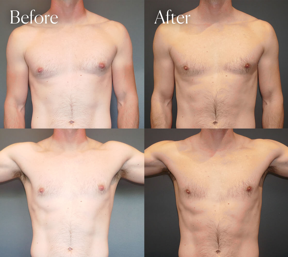 gynecomastia surgery colorado