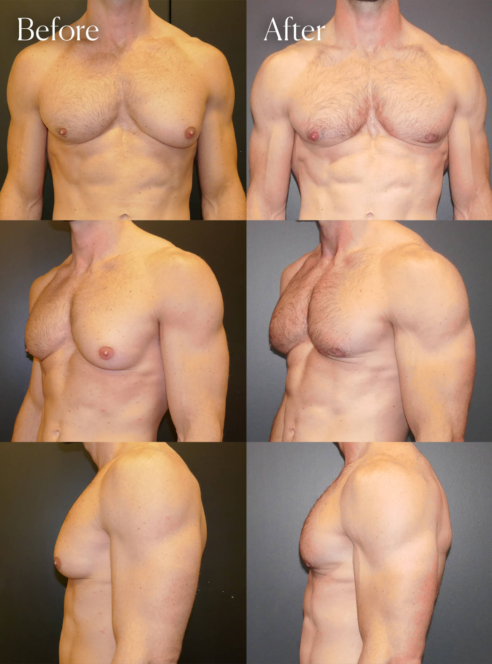 gynecomastia unilateral results