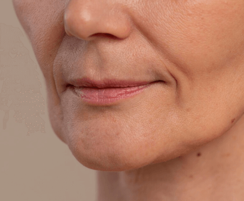 lip lift overview