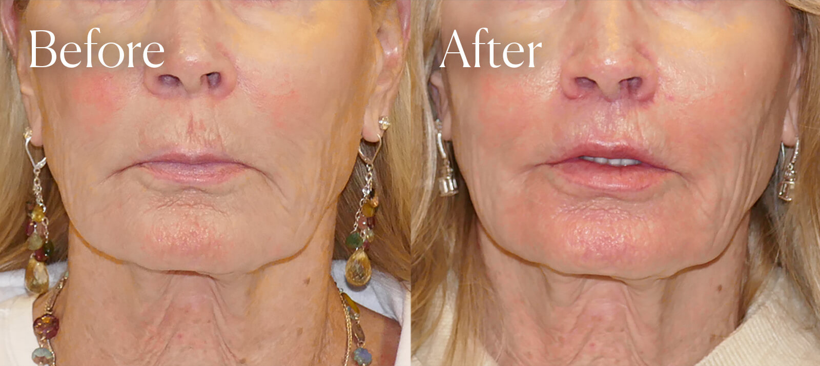 liplift facial enhancements