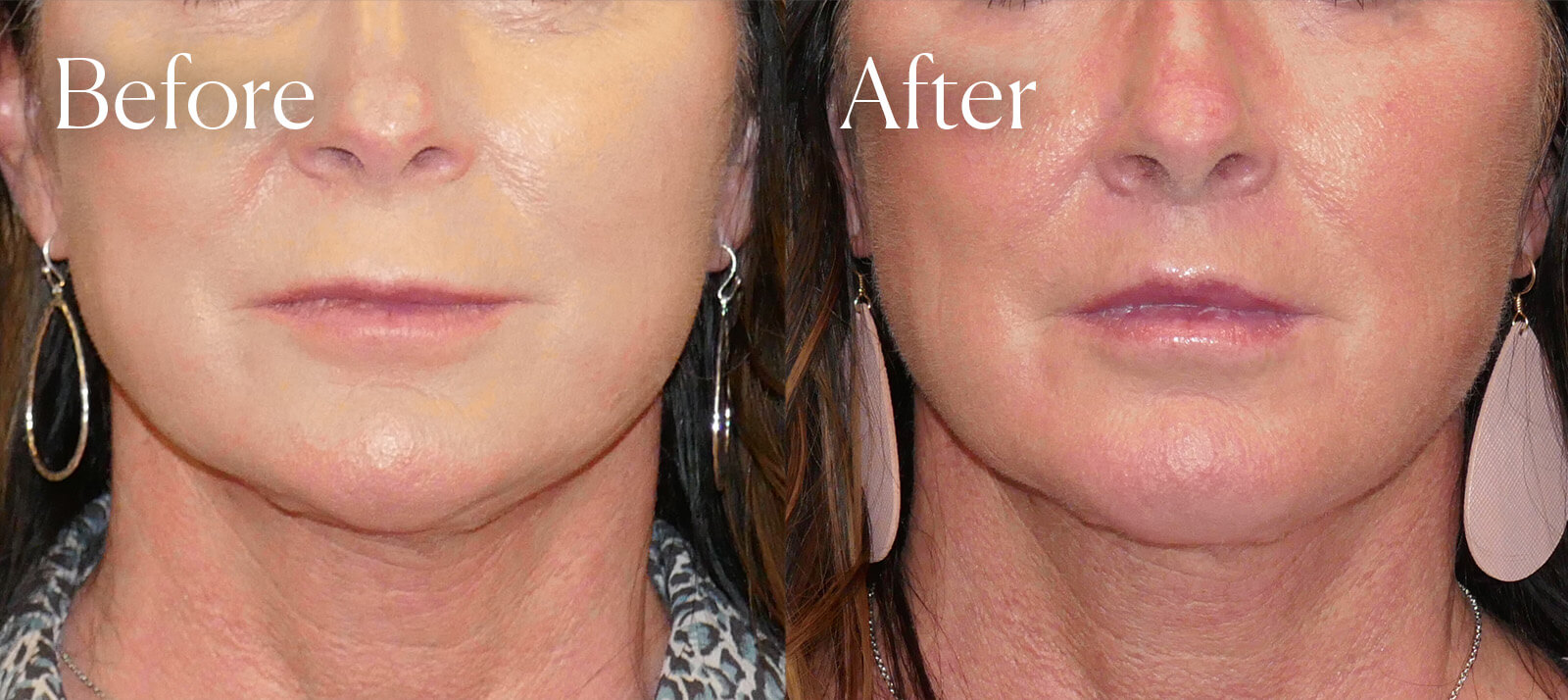 liplift facial surgery