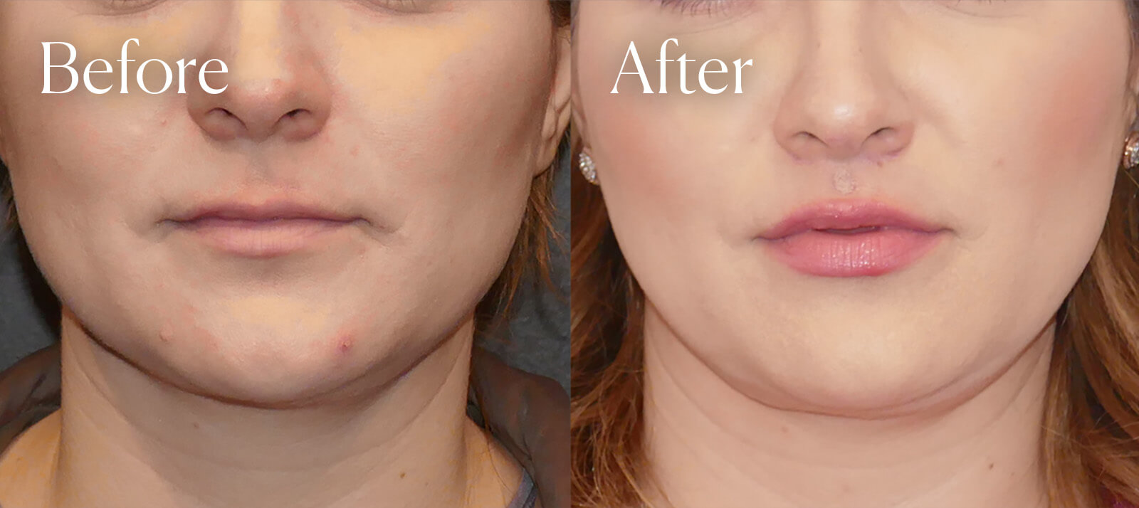 liplift procedure colorado