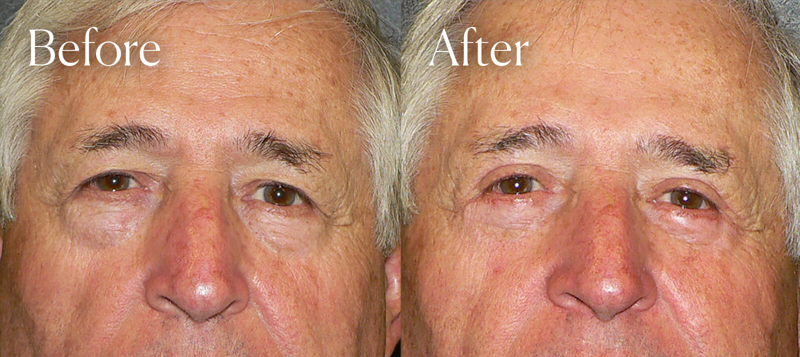 lower blepharoplasty aesthetic surgery