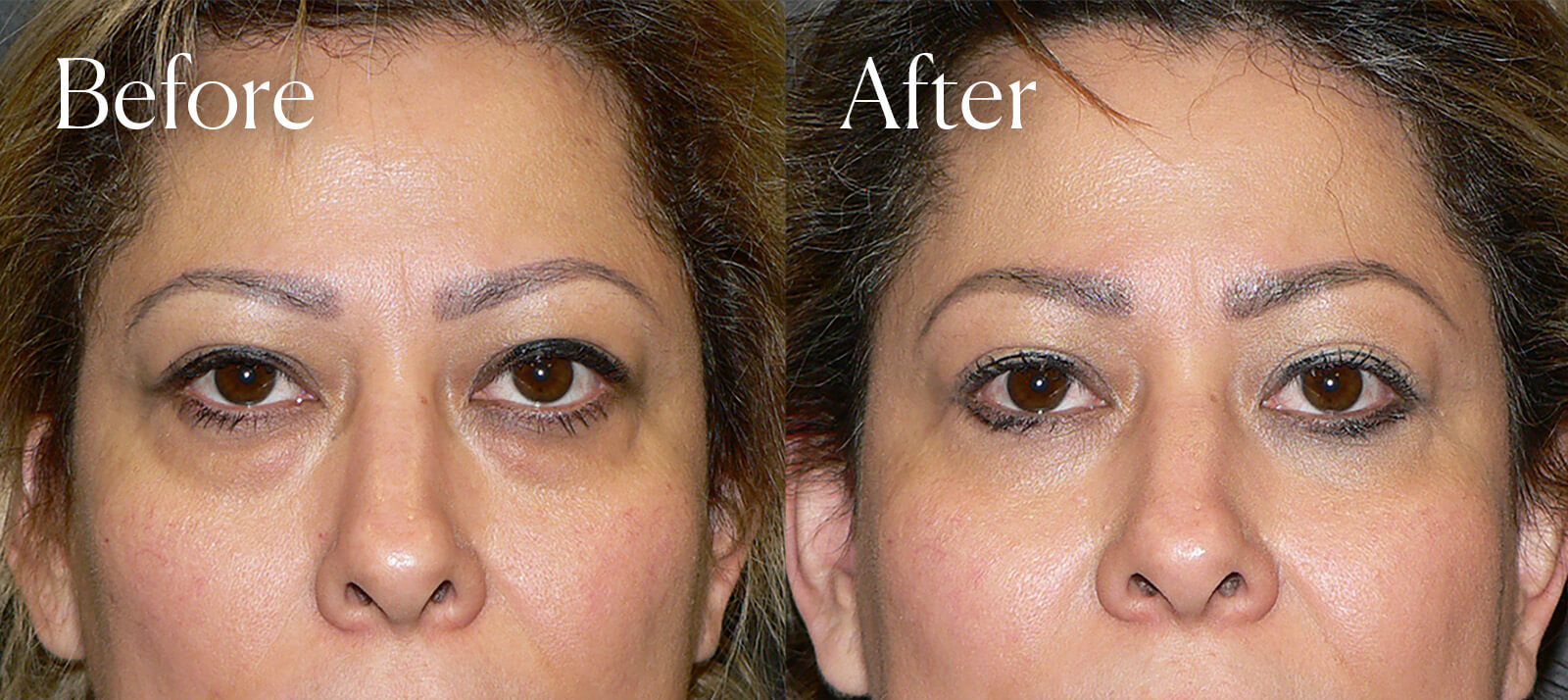 lower blepharoplasty plastic surgery