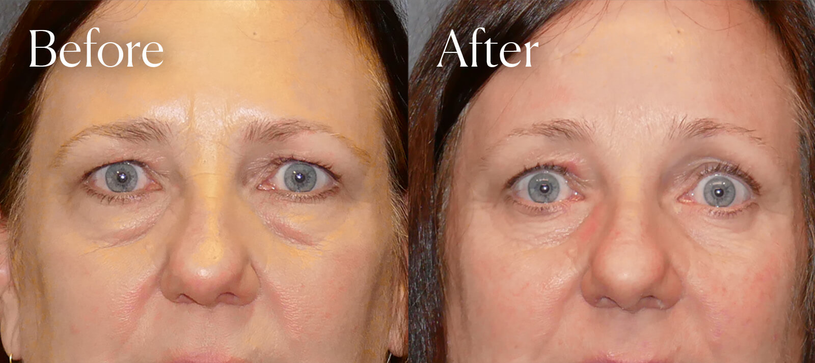 lower blepharoplasty procedure