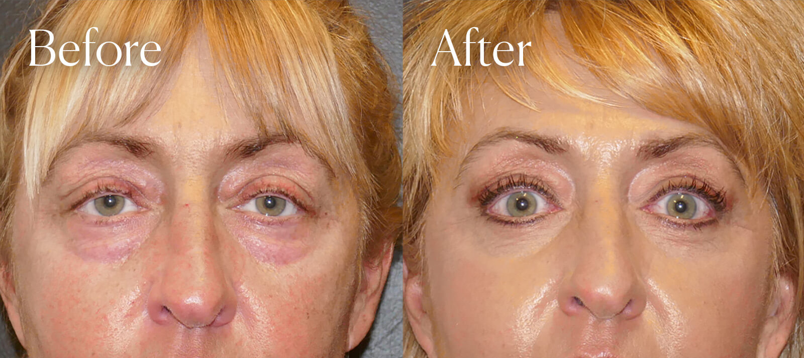 lower eyelid lift plastic surgery