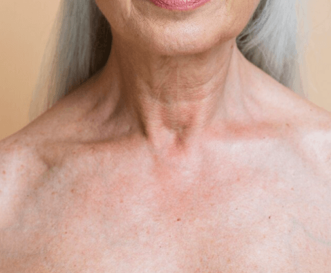 melasma treatment