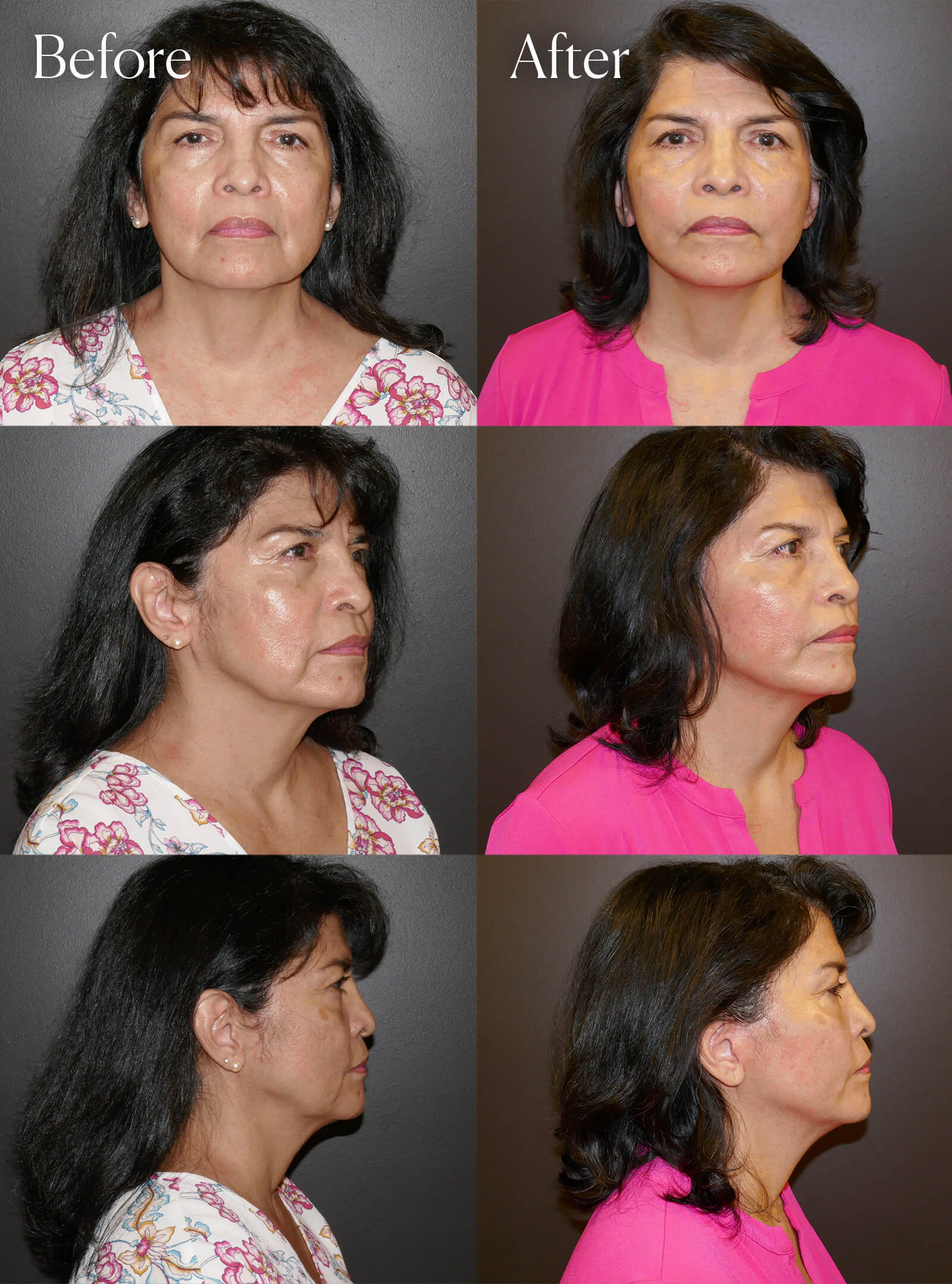 mini facelift aesthetic surgery