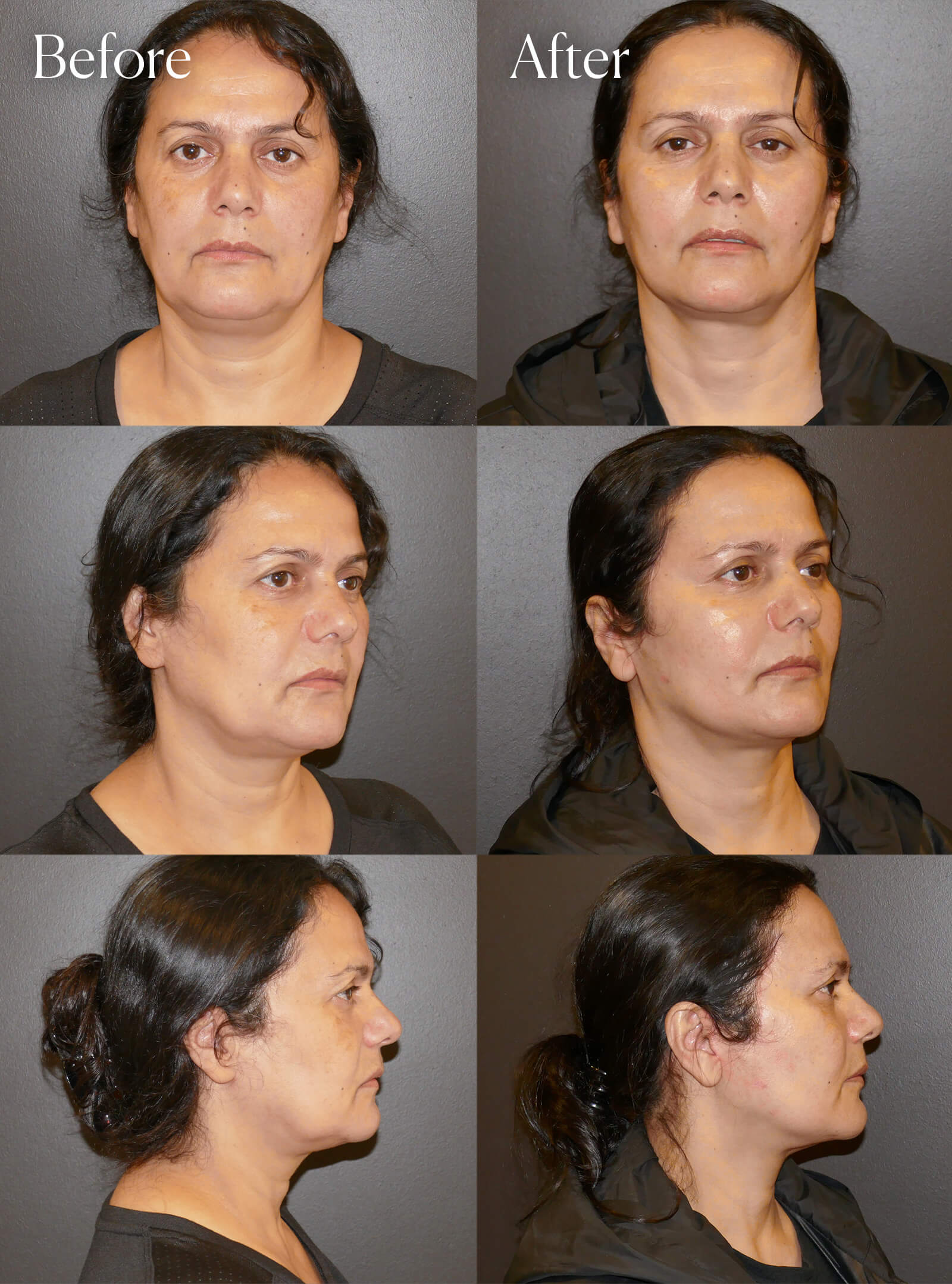 mini facelift facial enhancements