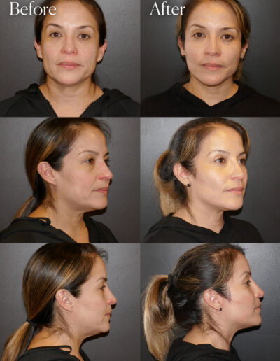 mini facelift smas plication results