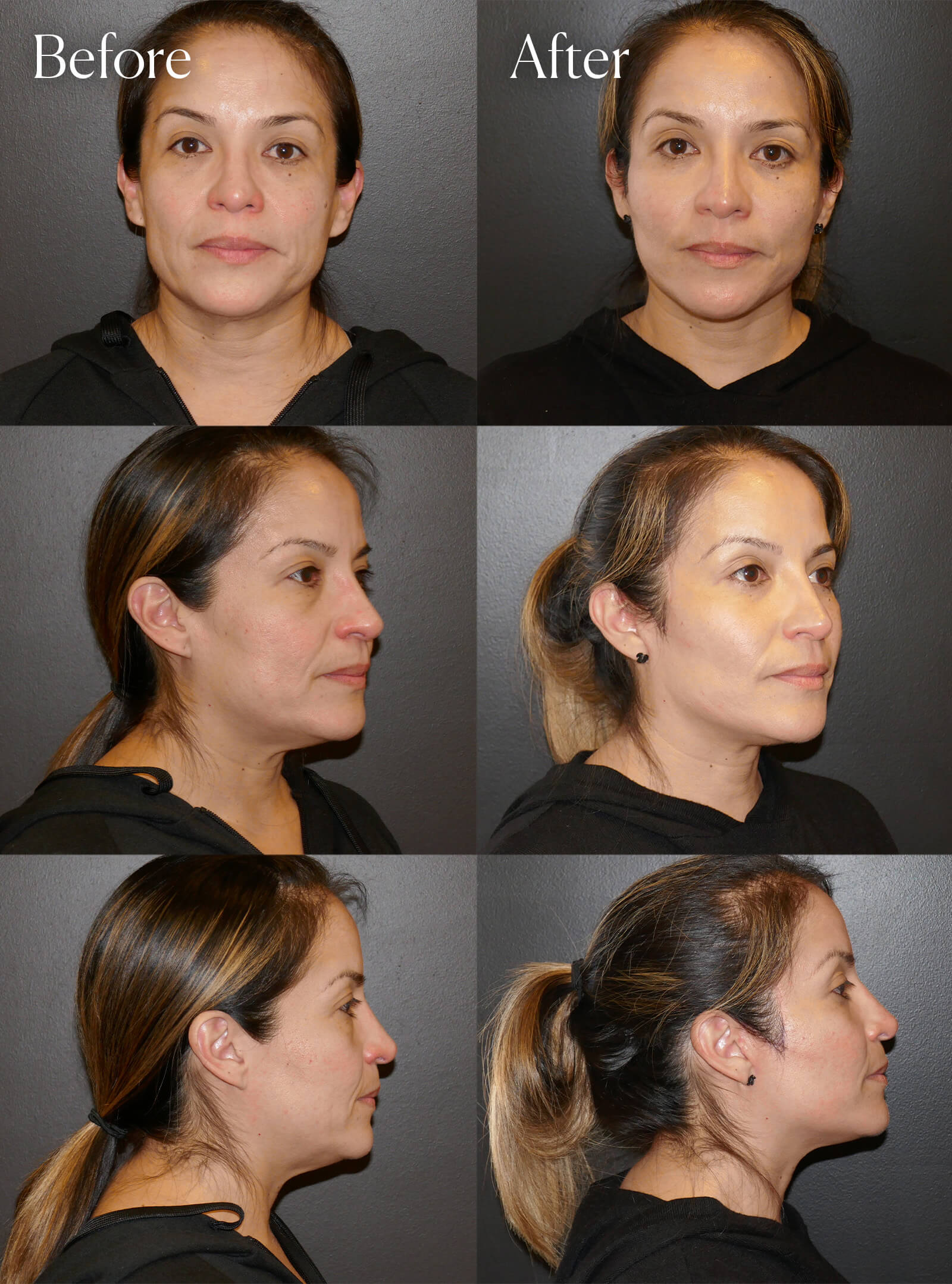 mini facelift smas plication results