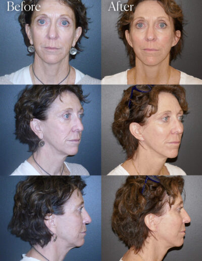 mini facelift smas plication surgery