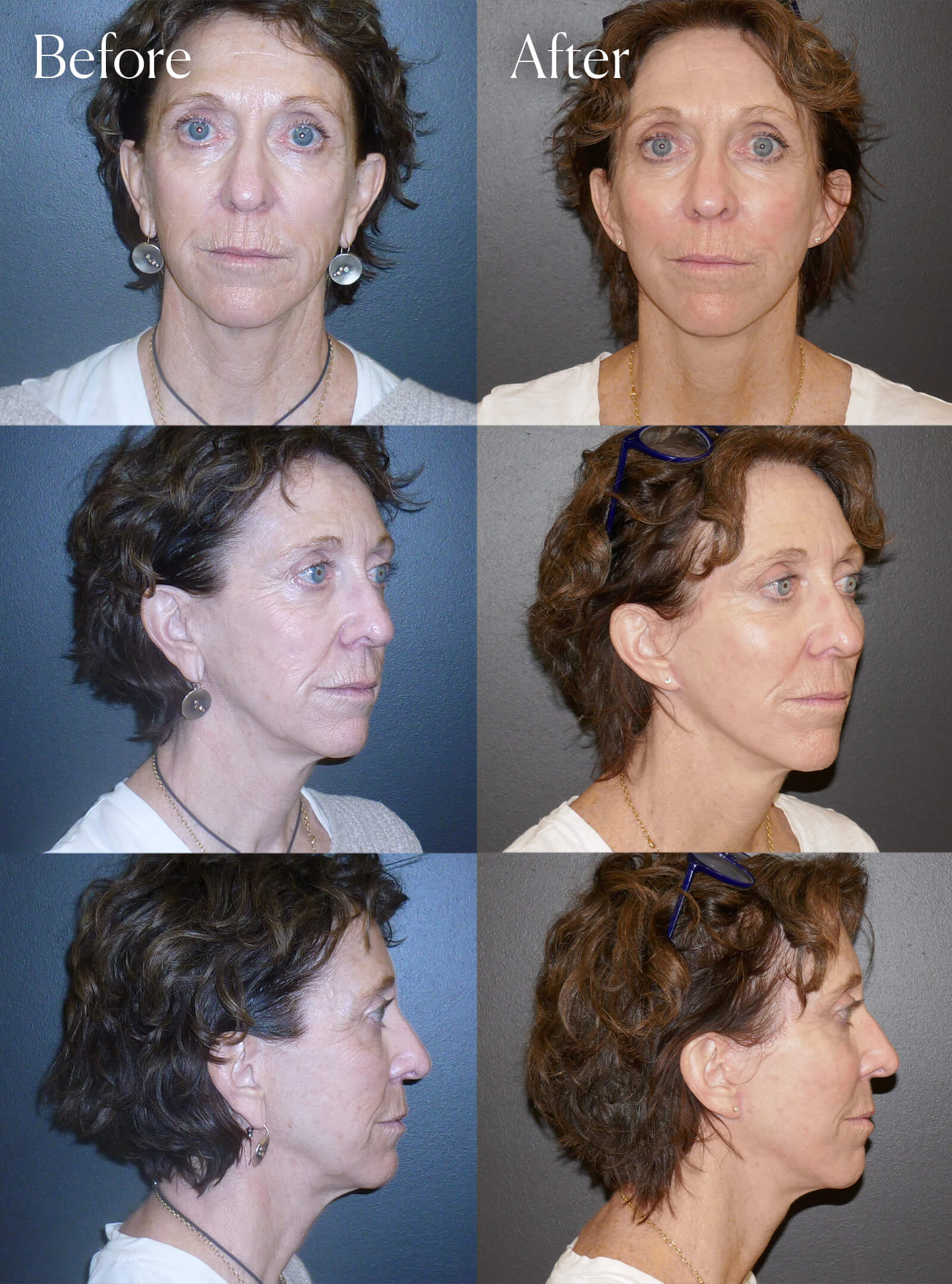 mini facelift smas plication surgery