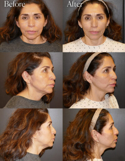 mini facelift surgery enhancements