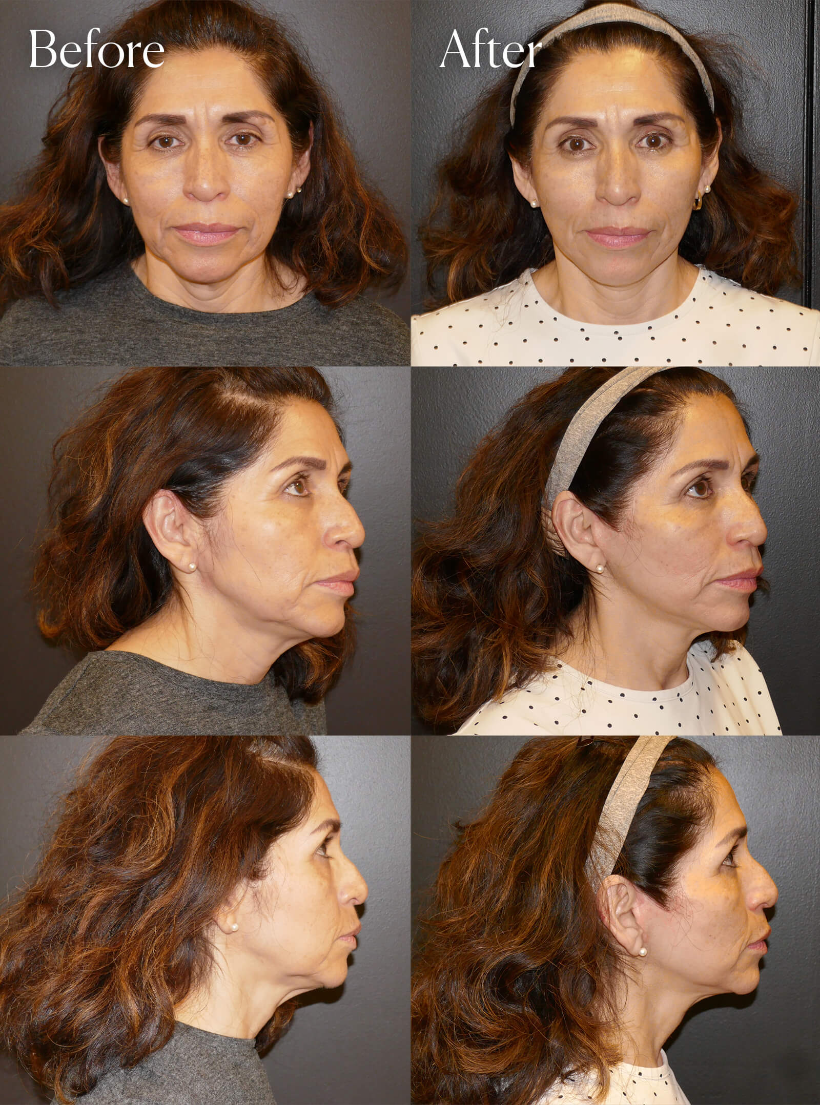 mini facelift surgery enhancements