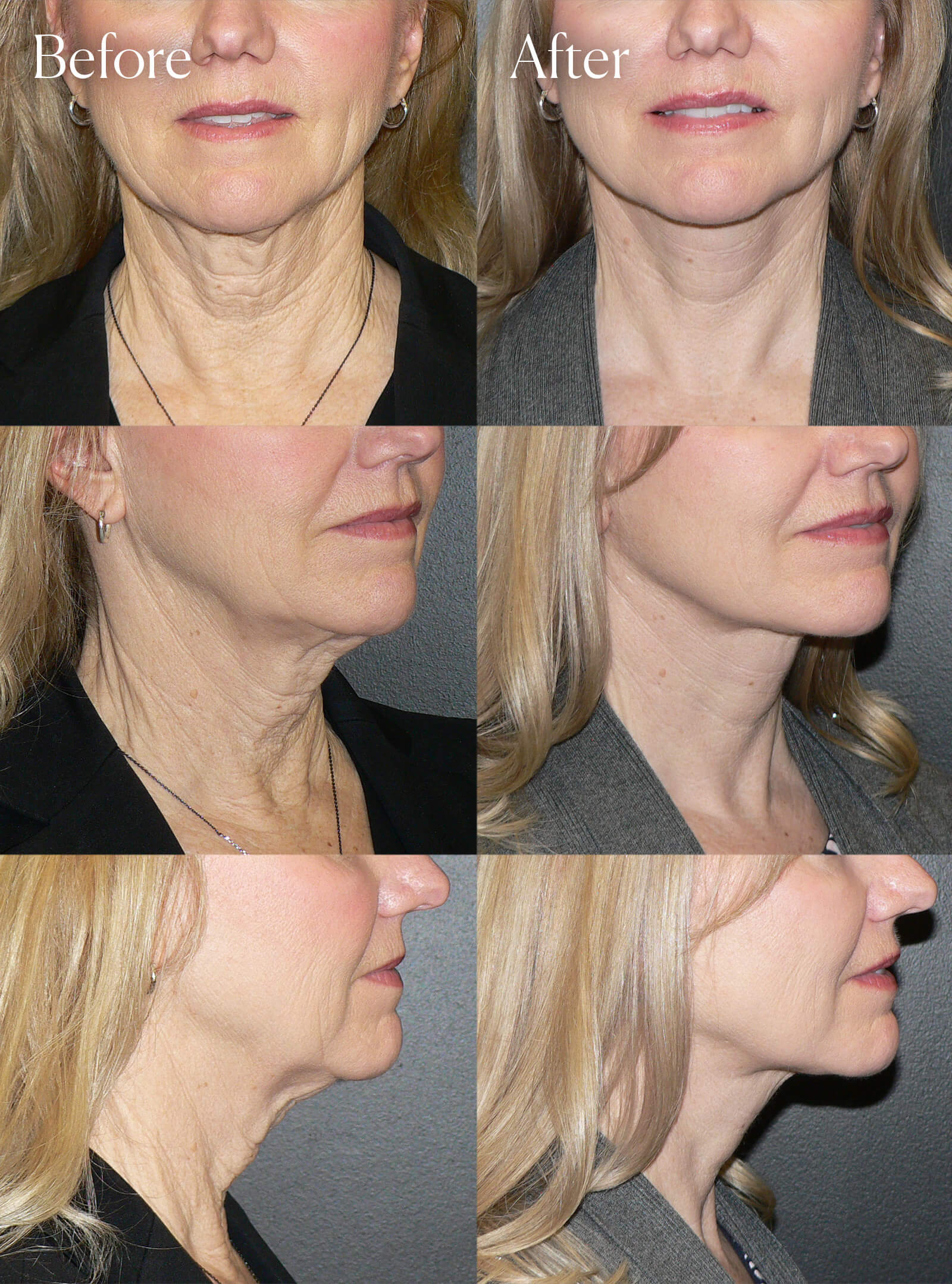 necklift plastic surgery