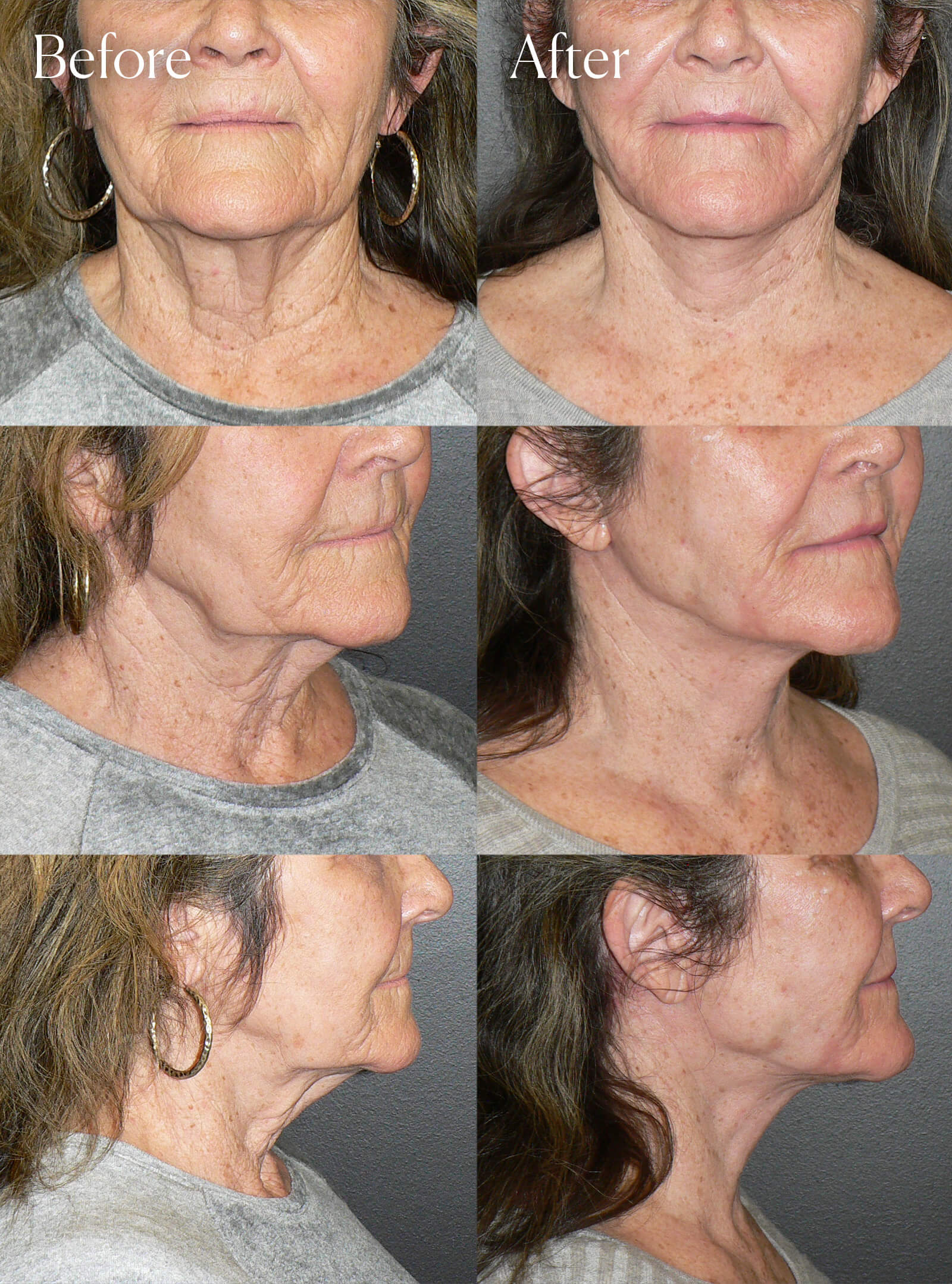 necklift procedure