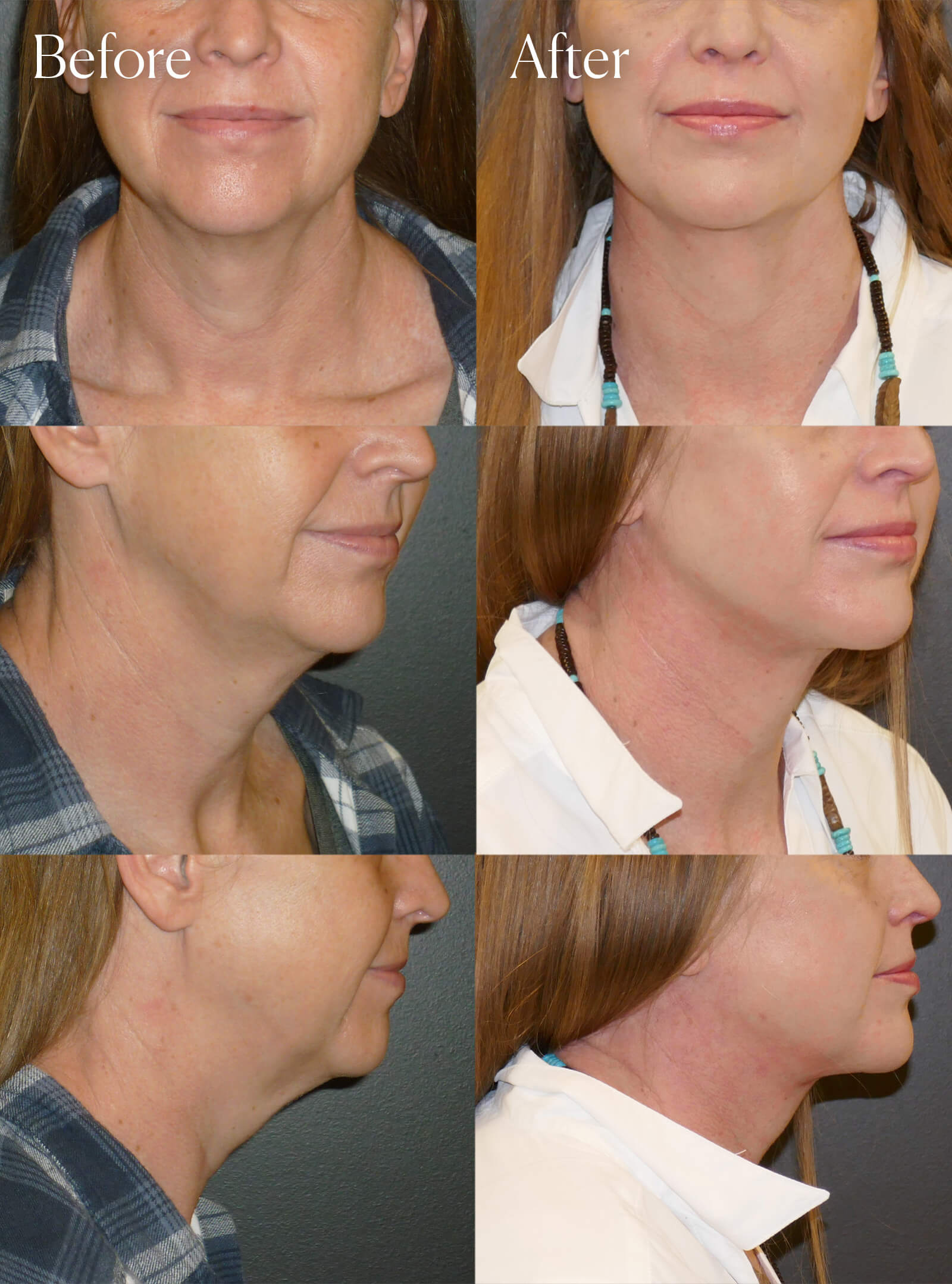 necklift surgery colorado