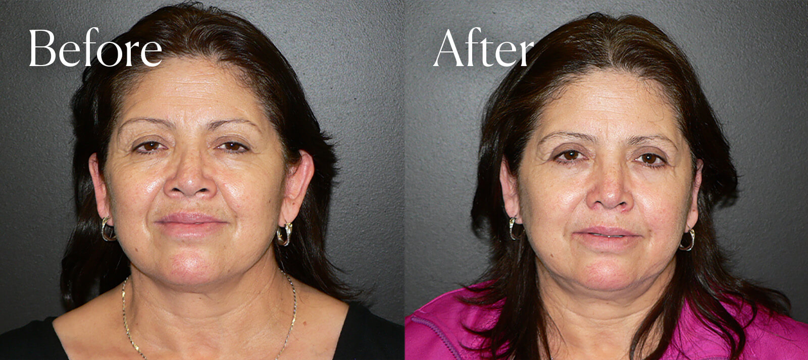 otoplasty facial enhancements