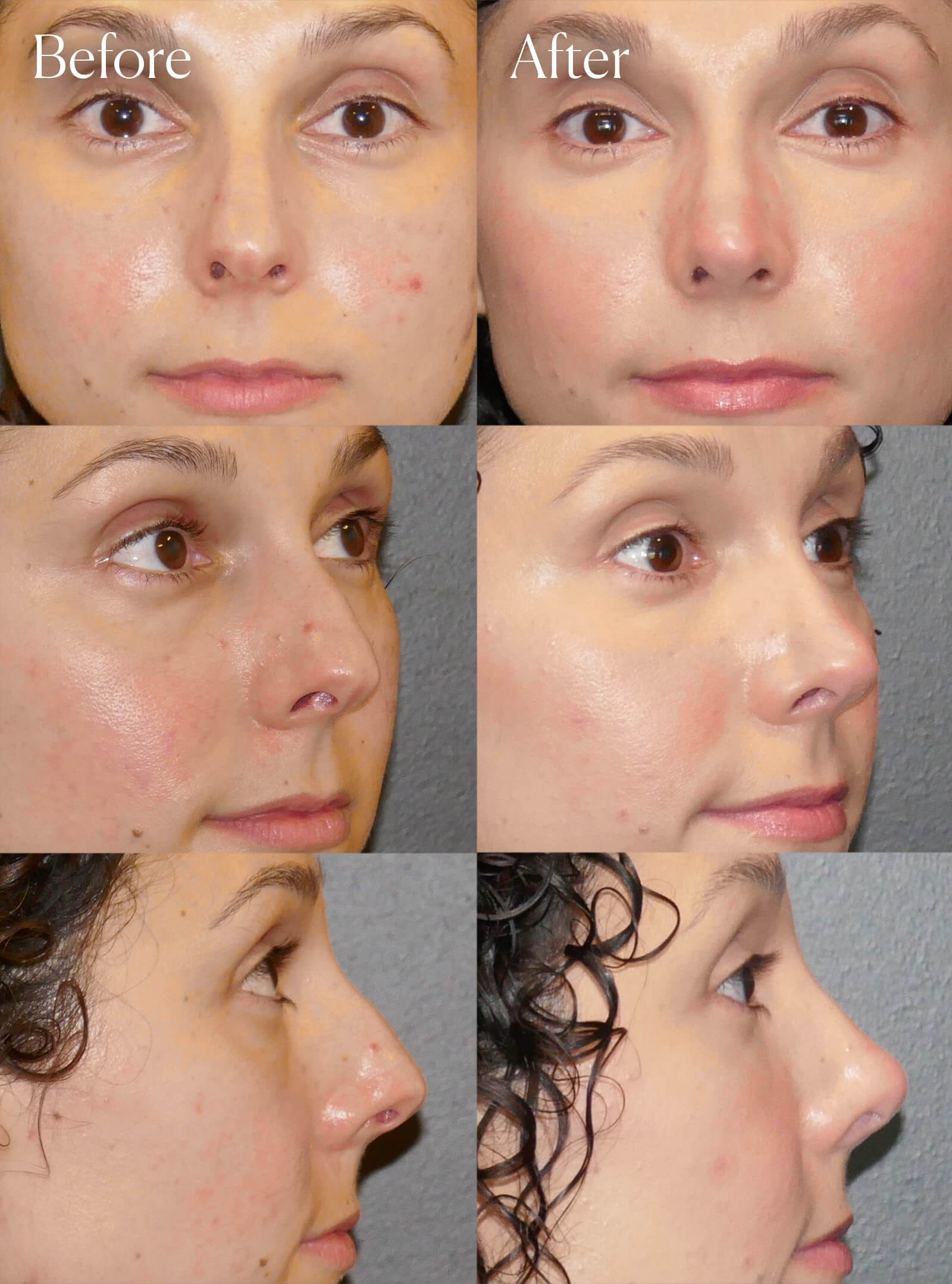 preservation rhinoplasty plastic surgery