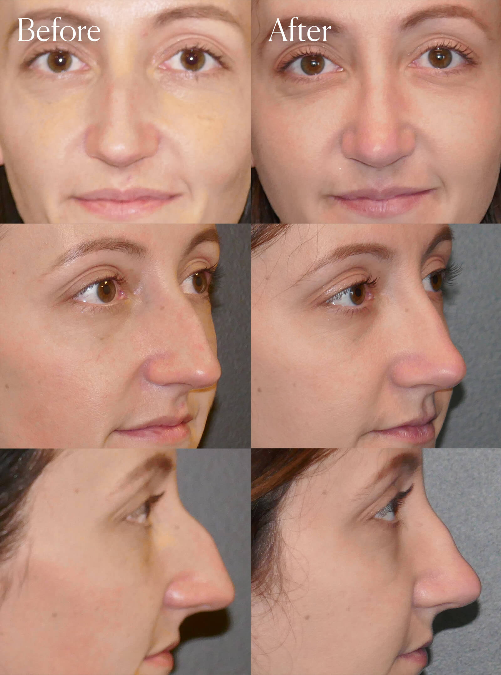 preservation rhinoplasty procedure colorado