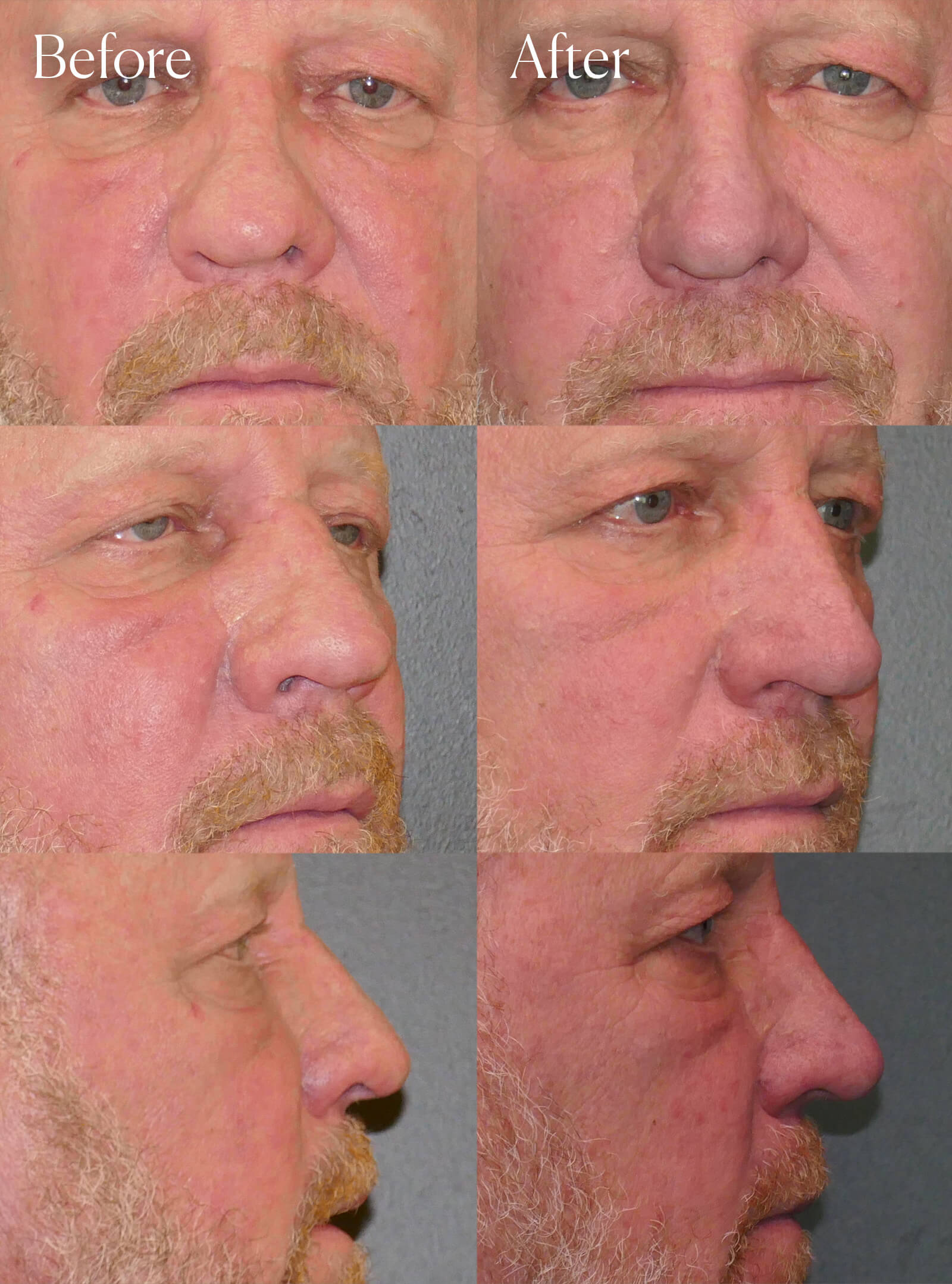 revision rhinoplasty aesthetic surgery